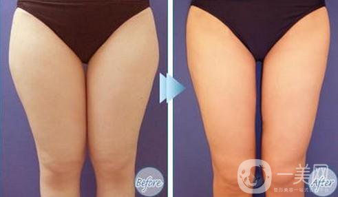 光纖溶脂瘦大腿好不好 適合哪些人做？