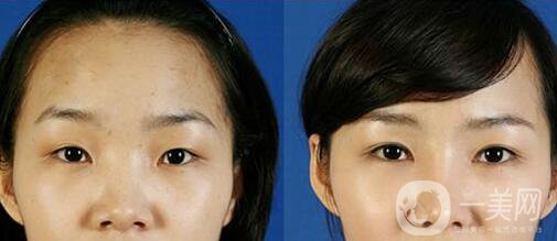 開內(nèi)外眼角多少錢？開眼角價格盤點！