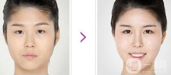 開眼角手術(shù)前后，術(shù)后*果杠杠的！