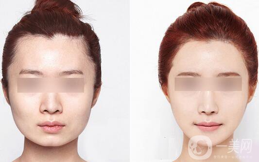 咬肌發(fā)達怎么辦？怎么處理？