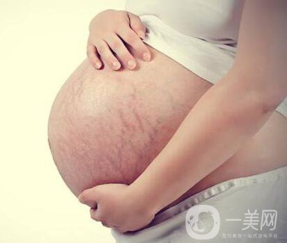 有妊娠紋怎么辦？什么方法**？
