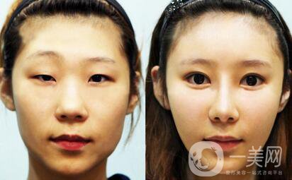 眼部抽脂前后，*果*看過來！