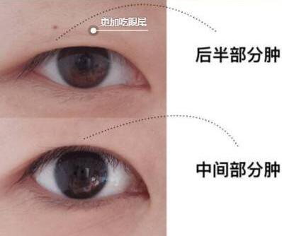 眼部抽脂前后，*果*看過來！