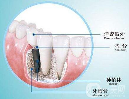 人工種植牙的價(jià)格要多少錢？