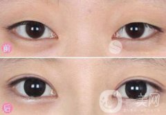 眼部手術都包含哪些項目？眼部手術整形多少錢