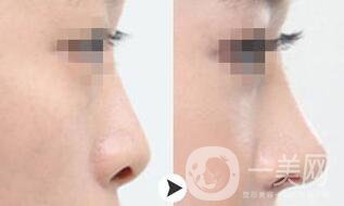 鼻小柱延長(zhǎng)手術(shù)一般都用什么材料