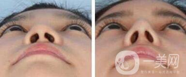 鼻小柱延長(zhǎng)手術(shù)一般都用什么材料