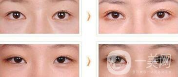 全切雙眼皮術(shù)后吃什么？術(shù)后如何護(hù)理