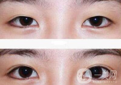 全切雙眼皮術(shù)后吃什么？術(shù)后如何護(hù)理
