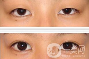 全切雙眼皮術(shù)后怎么護(hù)理？需要注意什么