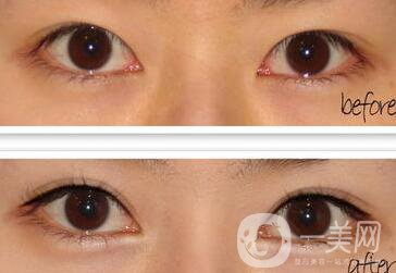 全切雙眼皮術(shù)后怎么護(hù)理？需要注意什么