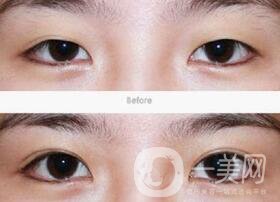 全切雙眼皮術(shù)后怎么護(hù)理？需要注意什么