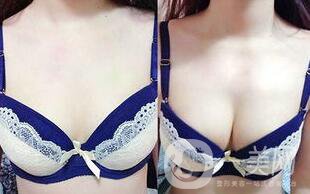 隆胸手術后多久恢復？術后注意事項有哪些