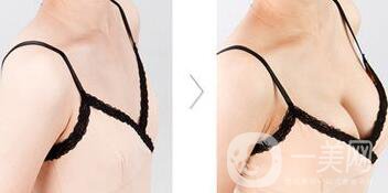 自體隆胸后多久可以上班？術(shù)后有哪些注意事項