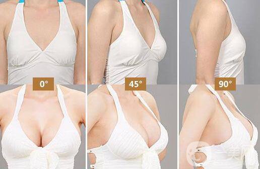 隆胸取出醫(yī)院介紹？隆胸取出后應(yīng)該要注意什么