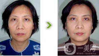 小切口拉皮除皺術(shù)