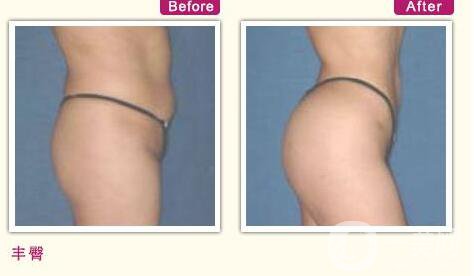 深圳,自體脂肪豐臀,價格