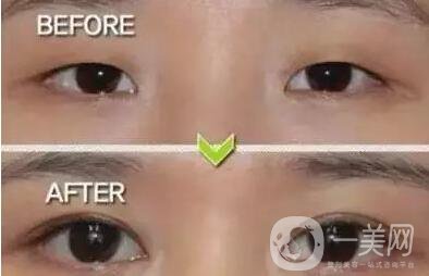 北京,開(kāi)眼角,醫(yī)院