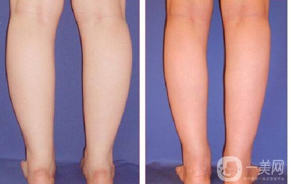 光纖溶脂瘦小腿,*果怎么樣,不適合哪些人