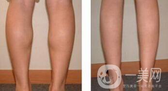 寧波射頻瘦小腿價格一般是多少錢