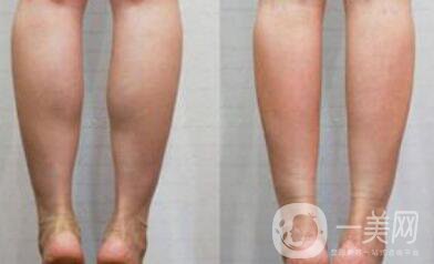 寧波射頻瘦小腿價格一般是多少錢