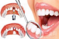 深圳種植牙手術價格大概是多少？