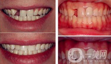 深圳種植牙手術(shù)價(jià)格大概是多少？