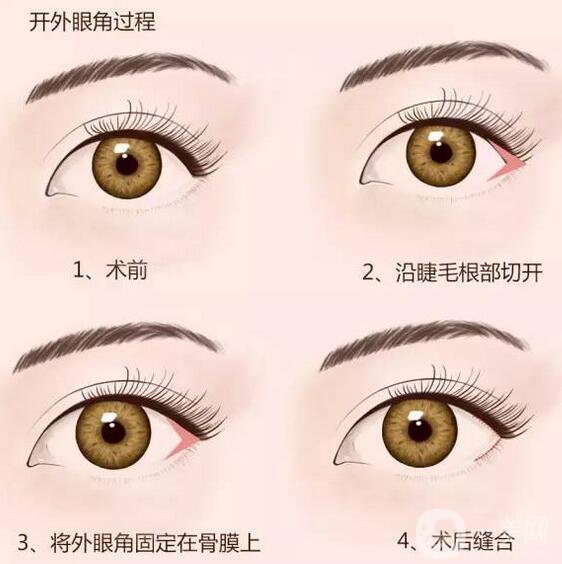 開(kāi)眼角*果怎么樣？手術(shù)風(fēng)險(xiǎn)大不大