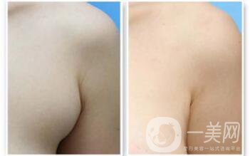 副乳是什么？副乳切除手術需要多久