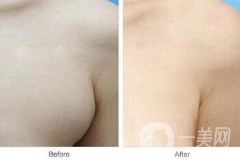 副乳是什么？副乳切除手術需要多久
