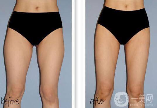 大腿吸脂多久恢復？大腿吸脂后遺癥有哪些