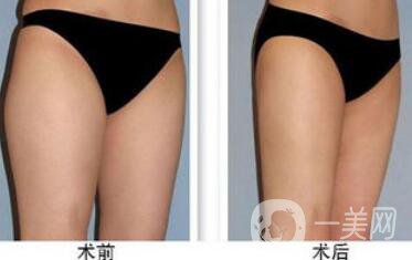 大腿吸脂多久恢復？大腿吸脂后遺癥有哪些