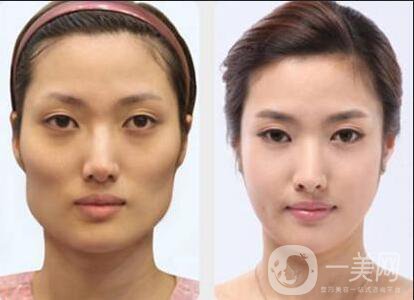 磨顴骨手術(shù)之后容易有后遺癥么？主要有哪些情況？