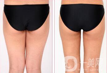 磨顴骨手術(shù)之后容易有后遺癥么？主要有哪些情況？