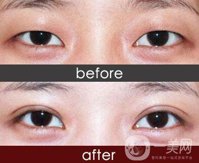 做完埋線雙眼皮手術需要注意什么