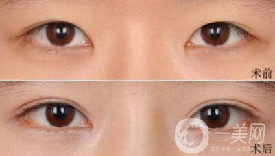 做完埋線雙眼皮手術需要注意什么