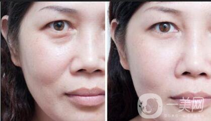 臉上長(zhǎng)法令紋怎么才能祛除 方法介紹