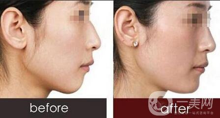 硅膠隆下巴分幾種手術(shù)方式 分別是哪些