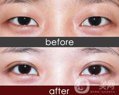 雙眼皮手術(shù)有哪些方法？做雙眼皮前要準(zhǔn)備什么