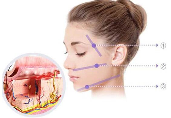 北京,非手術面部提升,大概需要多少錢