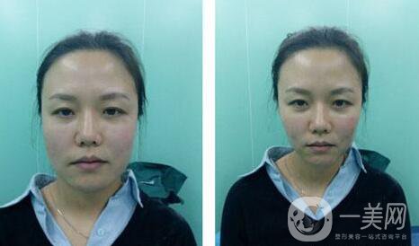 面部提升,多少錢