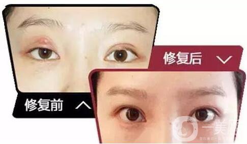 雙眼皮增生是什么樣子？