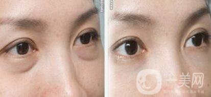 內(nèi)切祛眼袋失敗的原因 內(nèi)切祛眼袋后遺癥