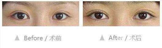 開眼角,適宜人群