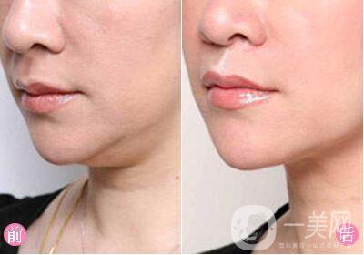 光纖溶脂去雙下巴多少錢？