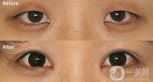 開(kāi)眼角,醫(yī)院