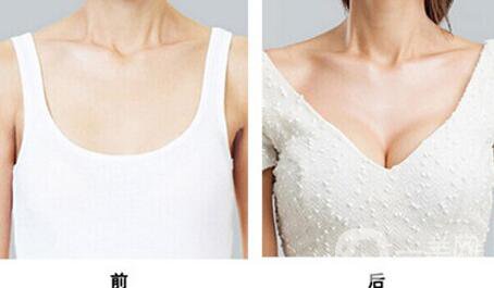 假體隆胸多久開(kāi)始按摩？具體如何操作