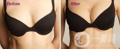 假體隆胸多久開(kāi)始按摩？具體如何操作