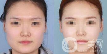 去頰脂墊瘦臉術(shù)前注意事項(xiàng)有哪些