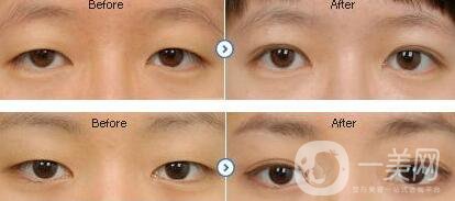 眼睛埋線后要注意什么 埋線獲得漂亮雙眼